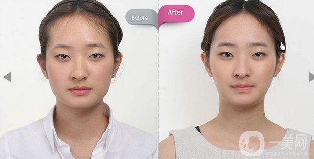 面部磨骨手術(shù)價(jià)格 面部磨骨手術(shù)多少錢(qián)