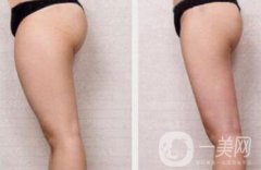 360度環(huán)形抽脂價(jià)格 吸脂減肥果圖