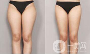 360度環(huán)形抽脂價格 吸脂減肥*果圖