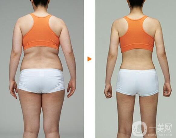 360度環(huán)形吸脂