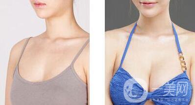 妙桃豐胸一次多少錢 妙桃假體隆胸具體價格