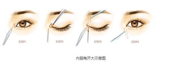 做開內(nèi)外眼角手術(shù)需要多少錢？