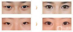 做開內(nèi)外眼角手術需要多少錢？