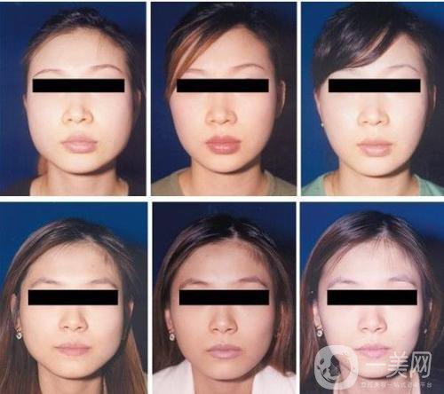 *一針價(jià)錢一般是多少？*果怎么樣？