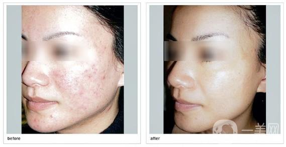 做一次果酸換膚大概需要多少錢？