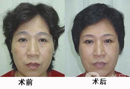 熱瑪吉除皺*果怎么樣？有哪些優(yōu)勢？