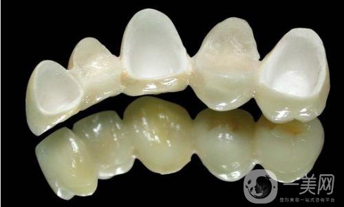 做美容冠矯正齙牙多少錢？