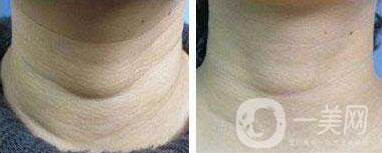 去頸紋