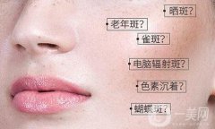 汗斑如何調(diào)節(jié) 汗斑調(diào)節(jié)法方法