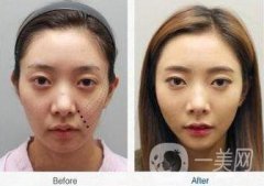 塑美極面部提升價格 塑美極面部提升要多少錢