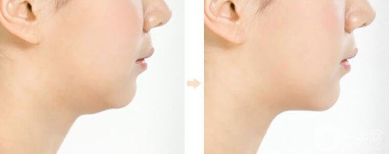 去雙下巴