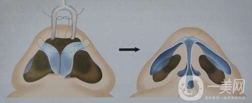 耳軟骨墊鼻梁大概需要多少錢(qián)呢？