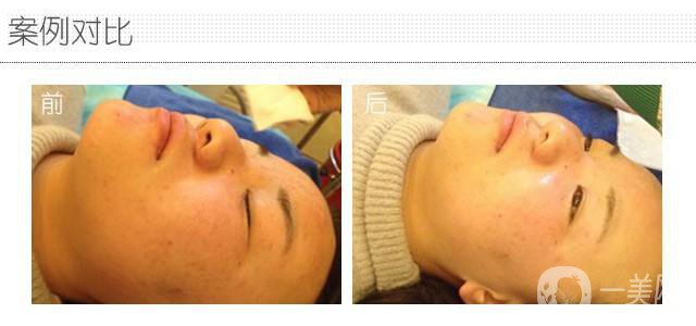 果酸換膚術(shù)做一次多少錢？