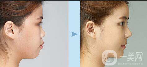 雙下巴抽脂手術(shù)一般需要多少錢(qián)？