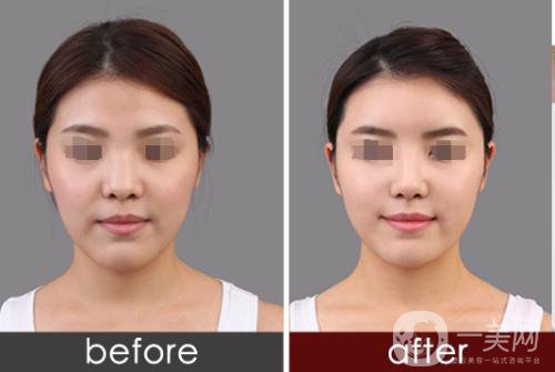 專業(yè)隆鼻修復(fù)手術(shù)的價(jià)格一般是多少？