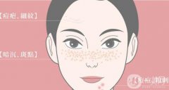 做果酸換膚會反彈嗎 果酸換膚會不會反彈