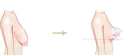 如何縮胸 胸部過大要怎么縮小