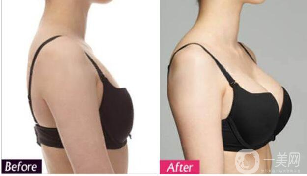 雙平面假體豐胸,怎么樣