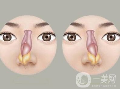 歪鼻子矯正手術(shù)多少錢 價格詳情