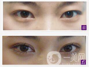 不開刀的雙眼皮方式有哪幾種？