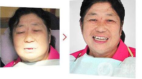 種植牙,優(yōu)點,缺點