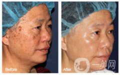 老年斑的形成 身上長(zhǎng)老年斑是什么原因