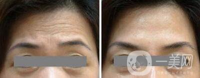 長(zhǎng)抬頭紋怎么辦 去抬頭紋*方法介紹