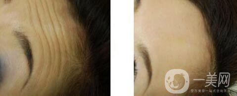 長(zhǎng)抬頭紋怎么辦 去抬頭紋*方法介紹