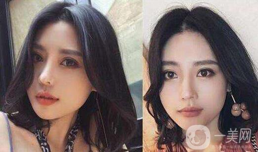 下頜角截骨手術(shù)費(fèi)用需要多少？