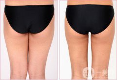 上臀吸脂減肥術(shù)價(jià)格一般是多少錢(qián)？