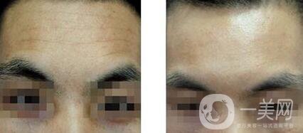 天生抬頭紋怎么消除 如何輕松去除抬頭紋介紹