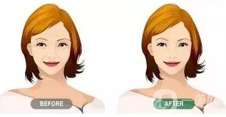 *生物除皺,*果,維持時(shí)間