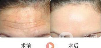 怎么治抬頭紋 超*的去抬頭紋方法介紹