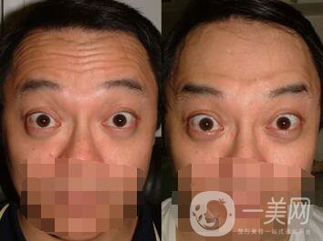 抬頭紋怎么治 消除抬頭紋*辦法