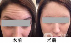 抬頭紋很重怎么辦 什么方法能夠去除抬頭紋