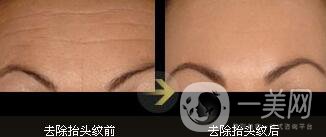 抬頭紋好不好 能夠*去除抬頭紋的方法