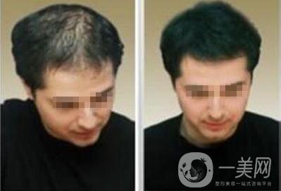 fut植發(fā),怎么樣