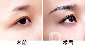 種植眉毛一般要多少錢 植眉價格詳解