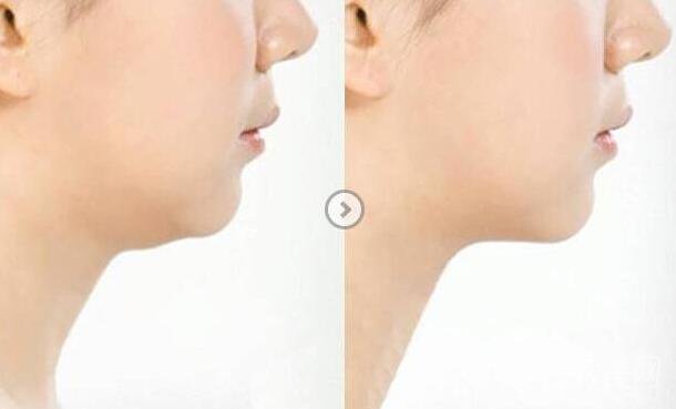 雙下巴抽脂多少價格 雙下巴吸脂具體費用介紹