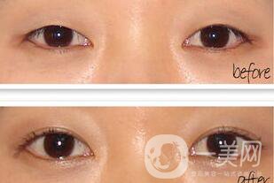 手術(shù)開眼角要多少錢 開眼角的費(fèi)用