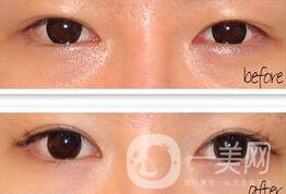 手術(shù)開眼角要多少錢 開眼角的費(fèi)用