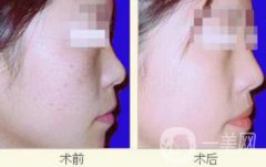 光子嫩膚*嗎 光子嫩膚好不好