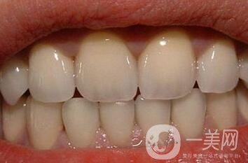 金鈀合金烤瓷牙優(yōu)缺點(diǎn)詳細(xì)介紹