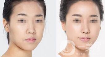 打玻尿酸后注意什么 注射玻尿酸如何護(hù)理