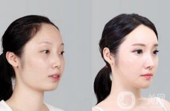 磨腮削骨多少錢(qián)？腮幫子磨骨多少錢(qián)？