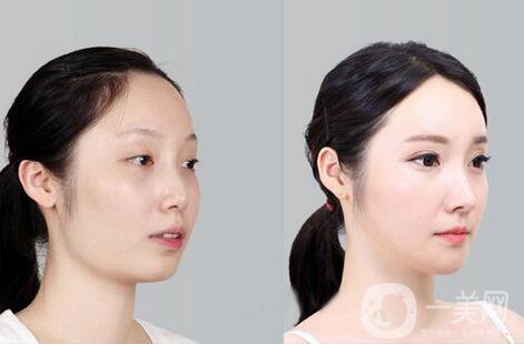 磨腮削骨多少錢？腮幫子磨骨多少錢？