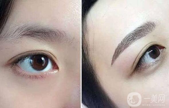北京眉整形多少錢？?jī)r(jià)格是多少？
