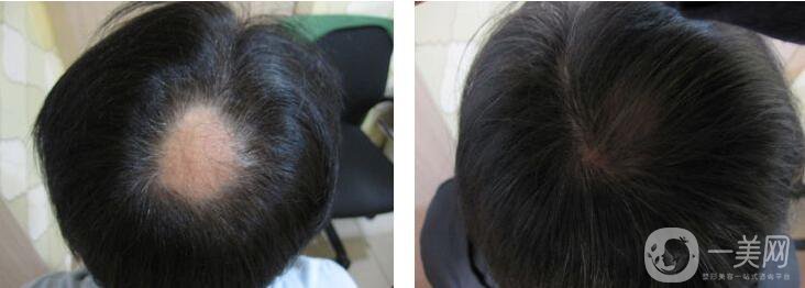 鄭州,植發(fā)醫(yī)院