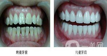 北京貴金屬烤瓷牙多少錢 貴金屬烤瓷牙價格詳解