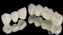 鈀銀合金烤瓷牙優(yōu)缺點(diǎn)有哪些 鈀銀合金烤瓷牙利弊